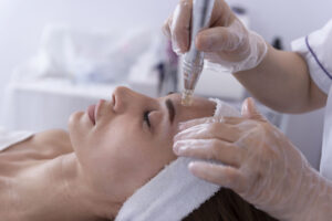 Microneedling im Gesicht mit Dermapen zur Hautverjüngung und Kollagenstimulation.